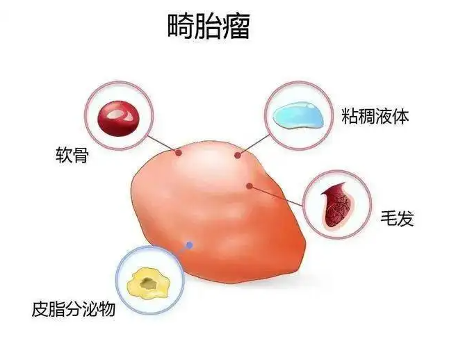 南阳59岁助孕龙凤胎：卵巢畸胎瘤如何治疗？